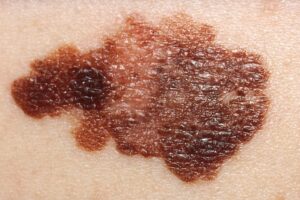 Câncer de pele tem cura? Tipos de tratamento