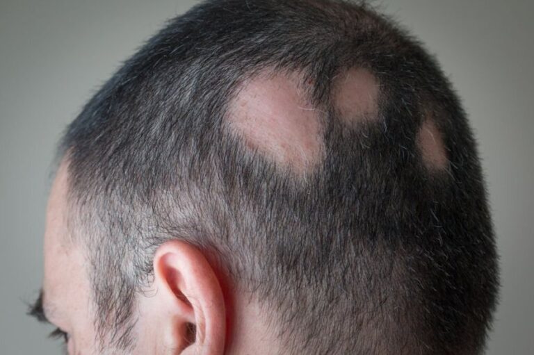 Alopecia Areata. Você sabe o que é?