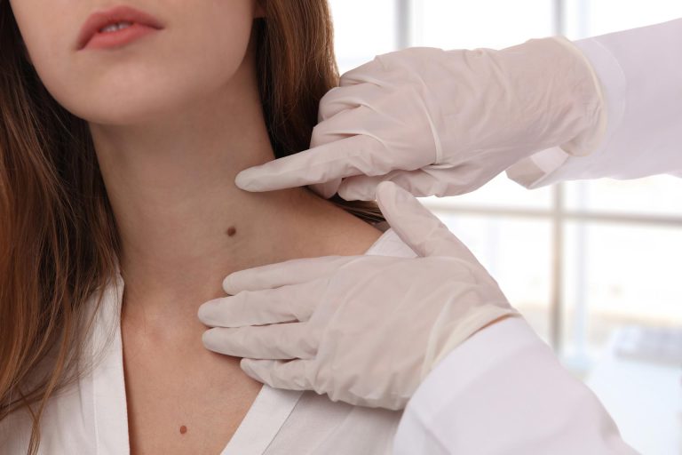 Câncer de pele: como prevenir e se proteger