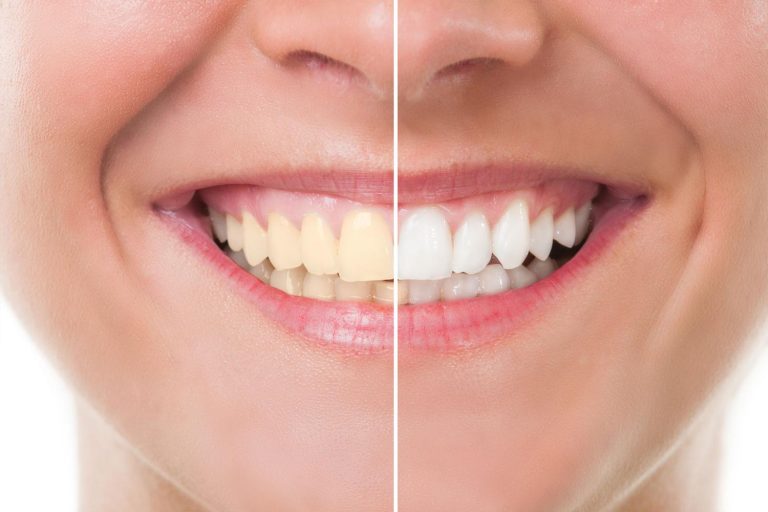 Clareamento dental: Como funciona? Mitos e verdades