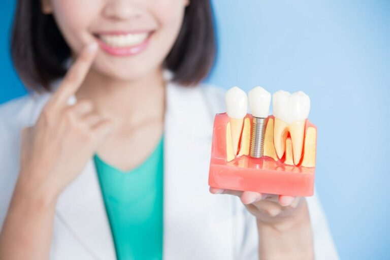 Implante dentário: É difícil fazer a manutenção? Tudo o que você precisa saber