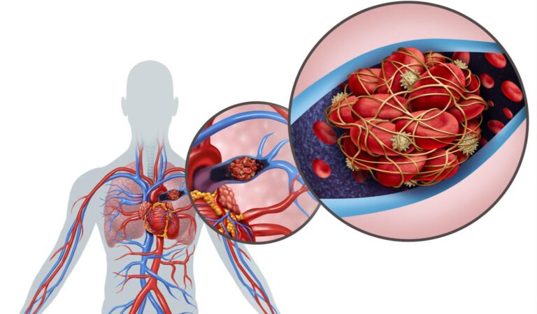 Embolia Pulmonar Desvendada: Diagnóstico, Tratamento e Prevenção