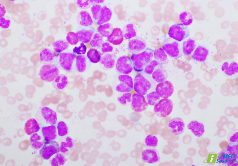 Leucemia: a importância do diagnóstico precoce e do tratamento adequado